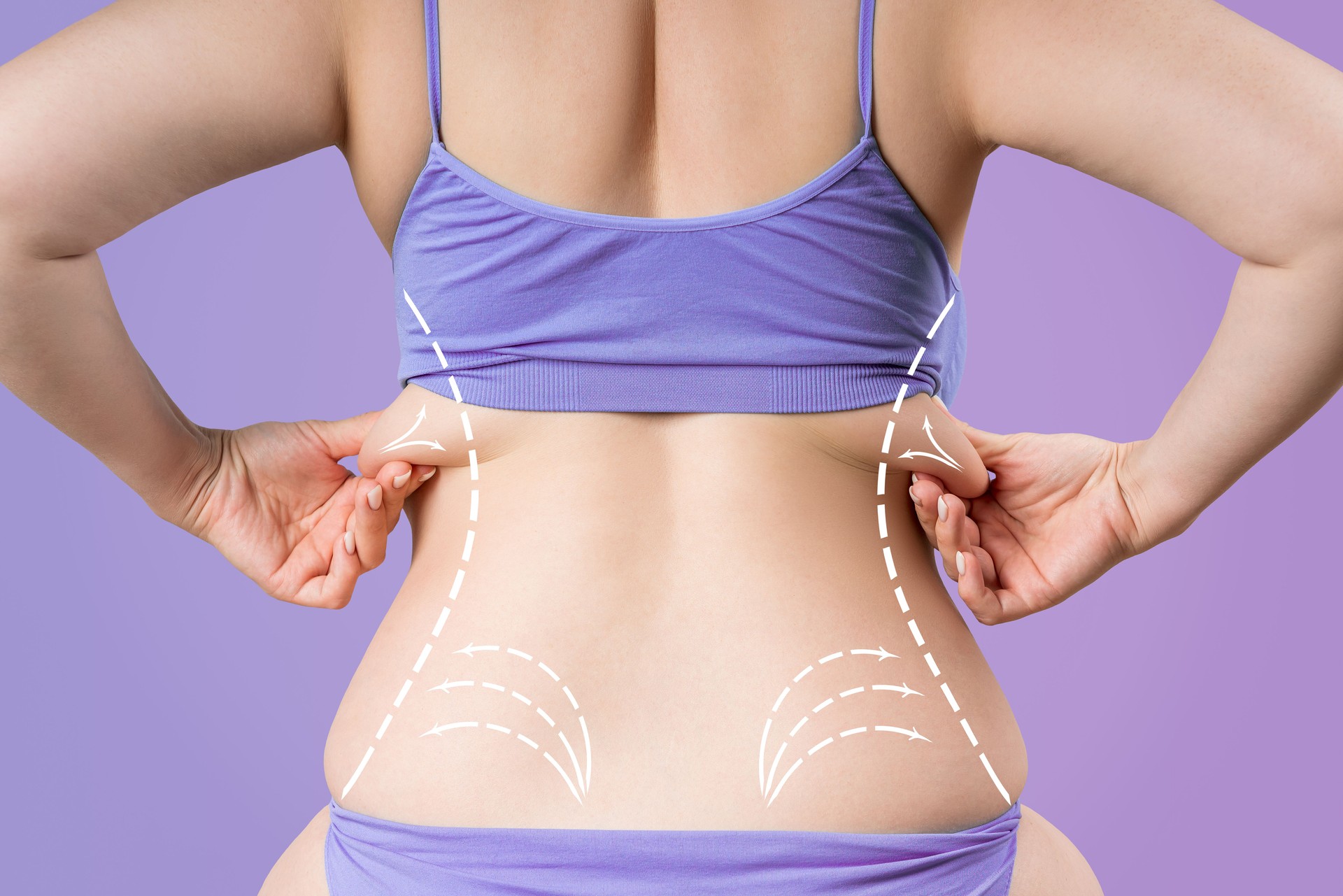 Back liposuction, fat and cellulite removal concept, overweight female body with painted surgical lines and arrows